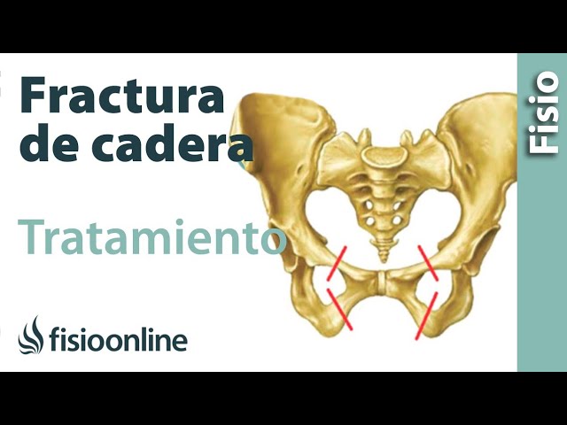 fractura de pelvis cuidados en casa