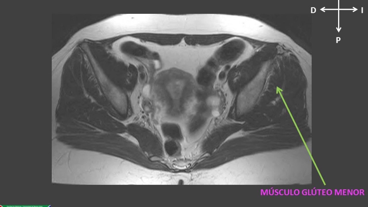 que se ve en una resonancia de pelvis