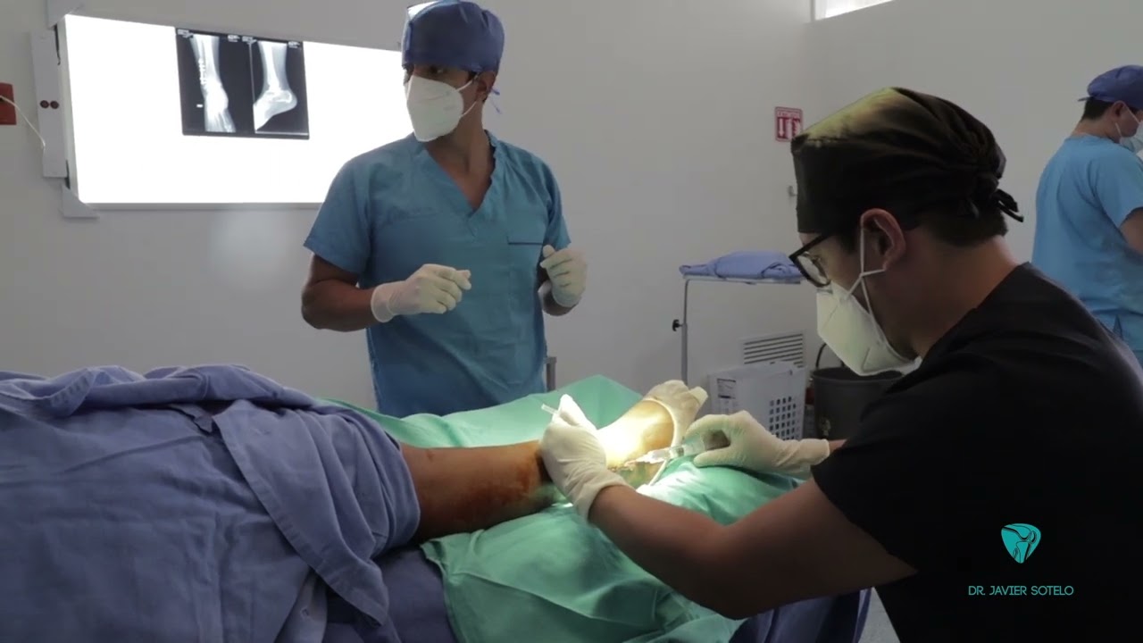 operación de peroné con placa y tornillos