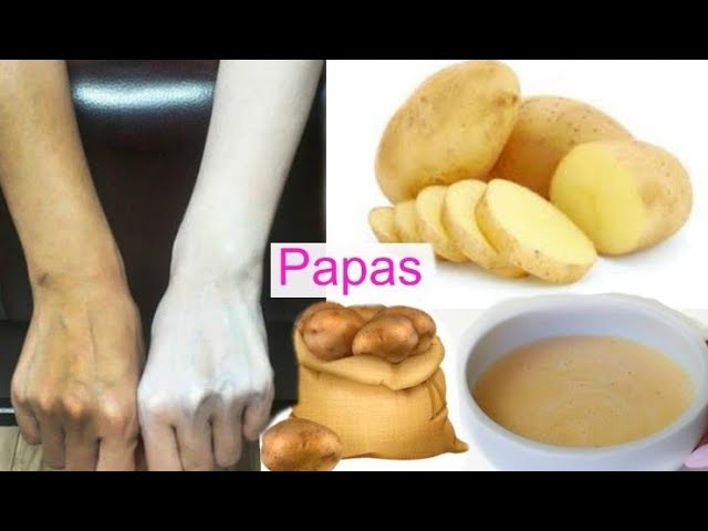 Blanquea tu piel con papa y bicarbonato