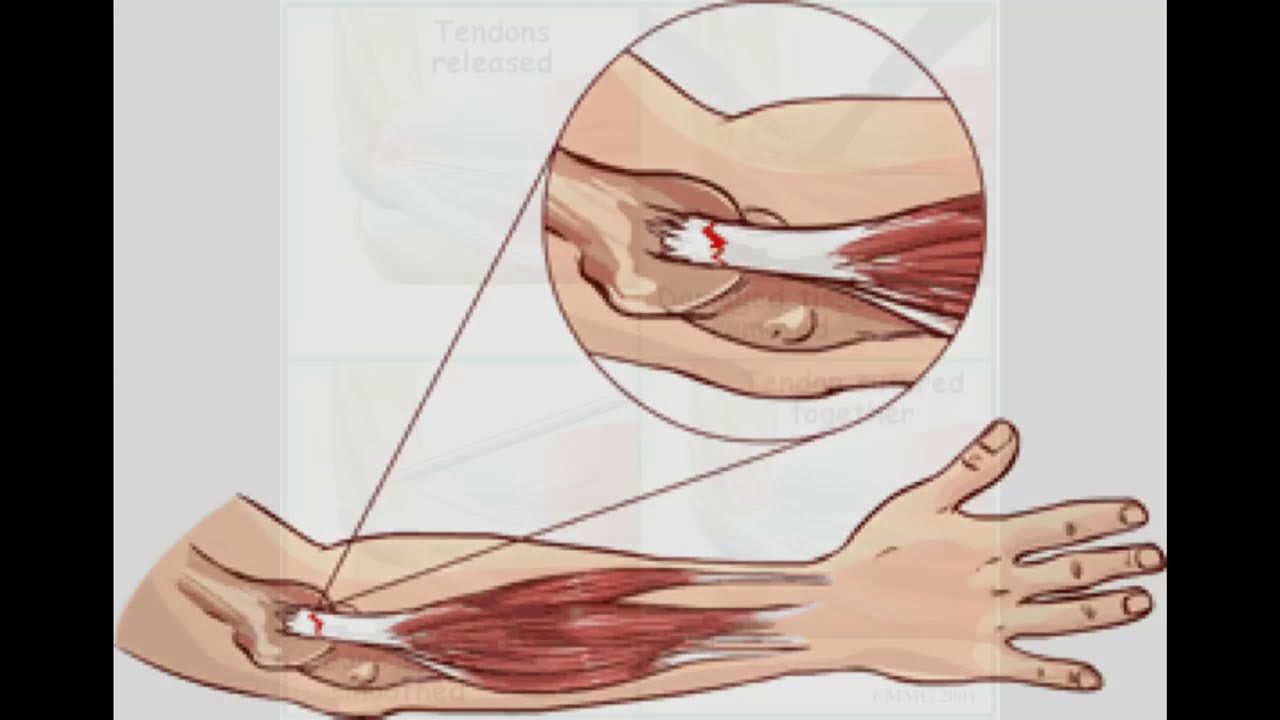 rotura parcial tendón extensor codo tratamiento