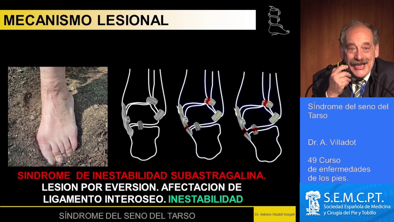 dolor en el seno del tarso