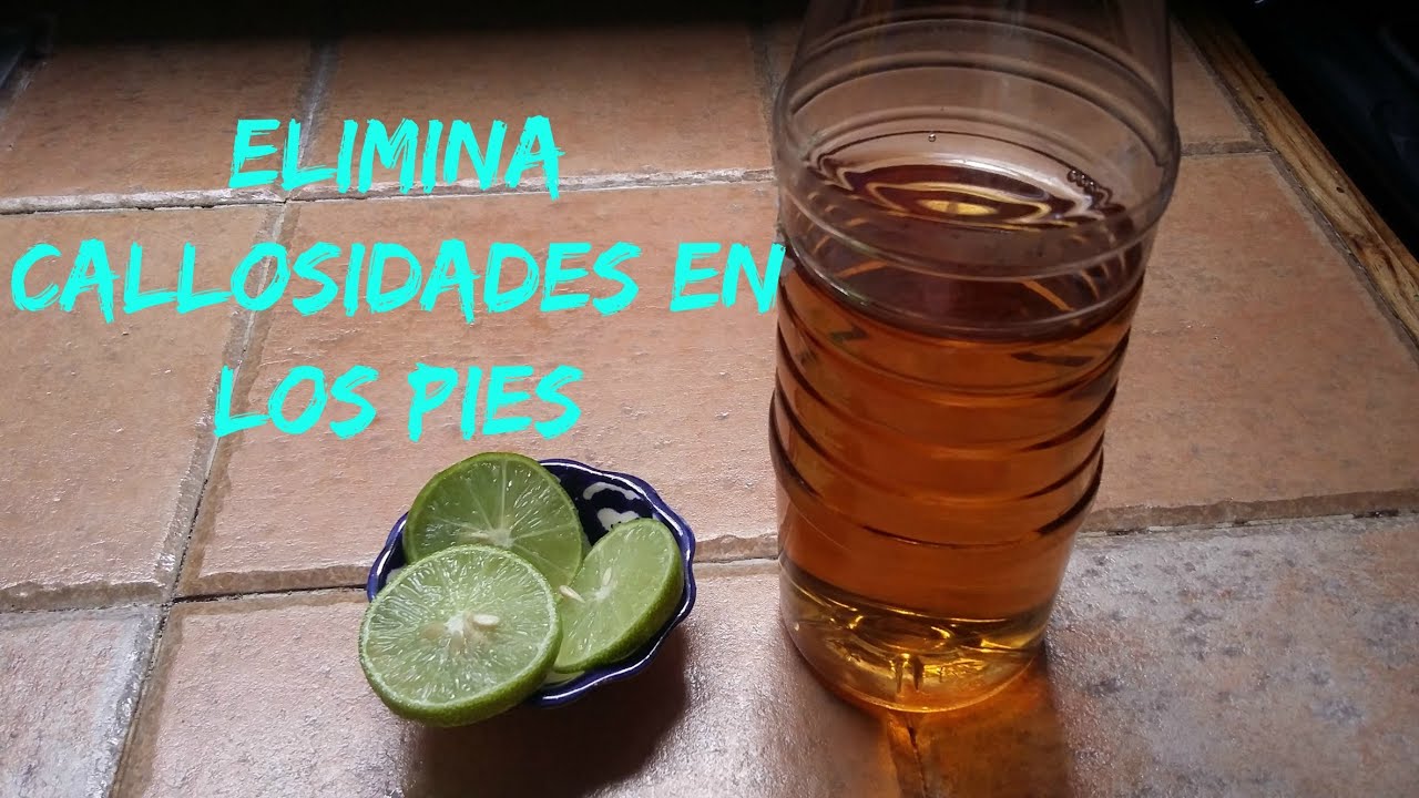 Remedios caseros efectivos para tratar callos en los pies