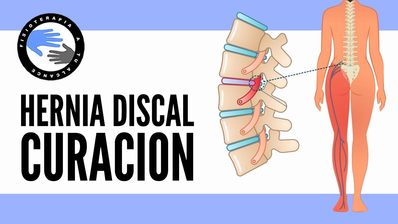 cuanto dura una baja por hernia discal lumbar