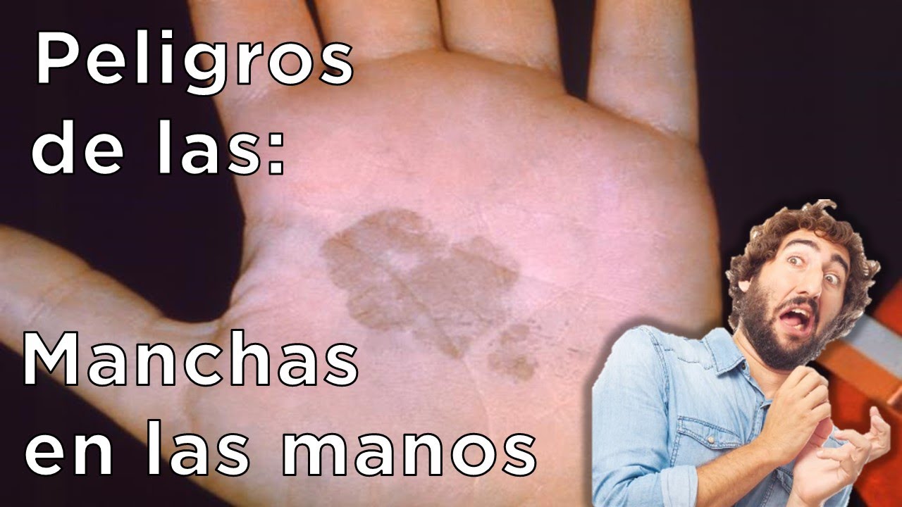 manchas en la palma de la mano color café