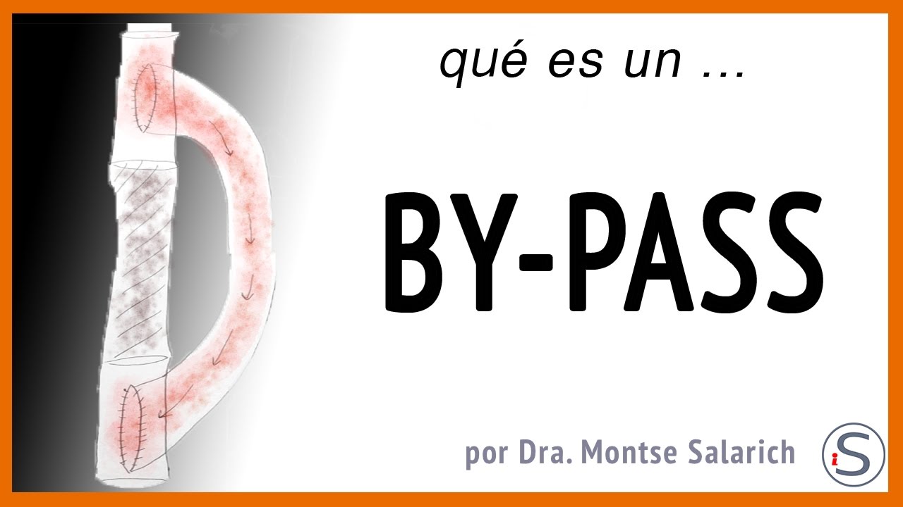 que es un bypass en la pierna