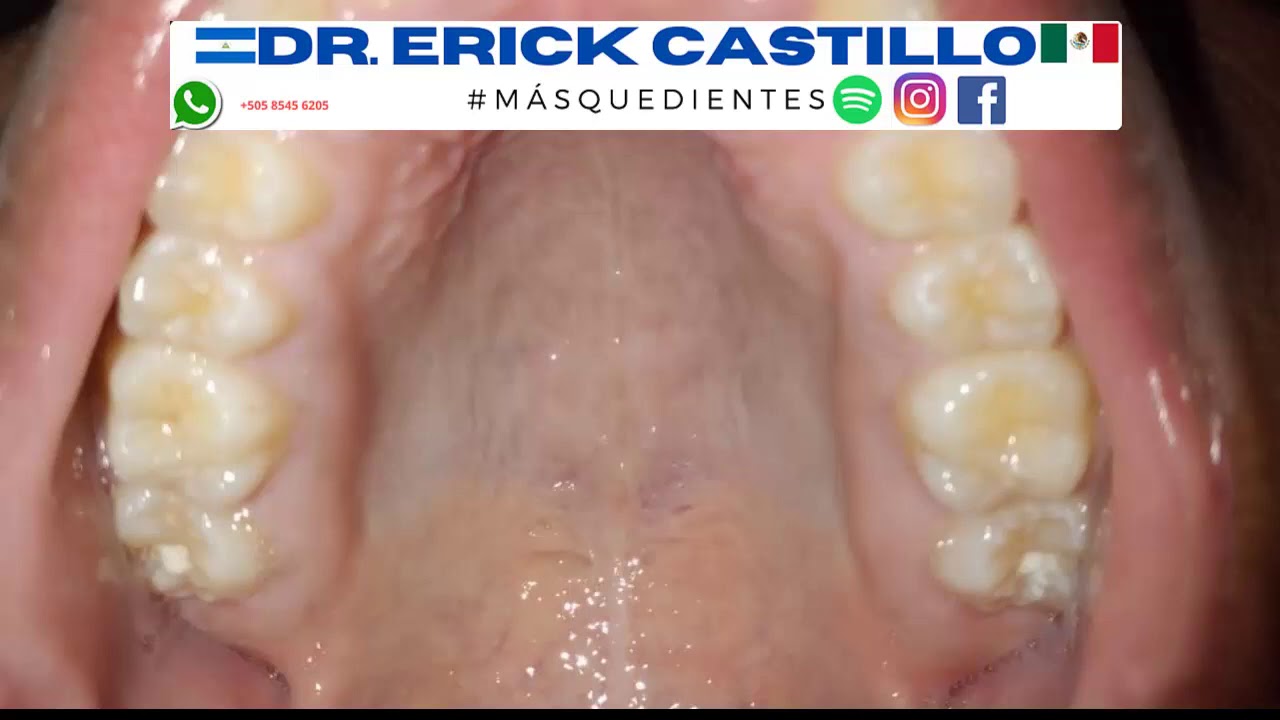 qué pasa si tengo el paladar amarillo