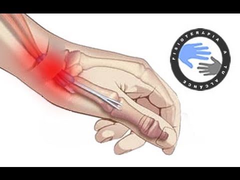 tiempo de baja por operación de tendinitis de quervain