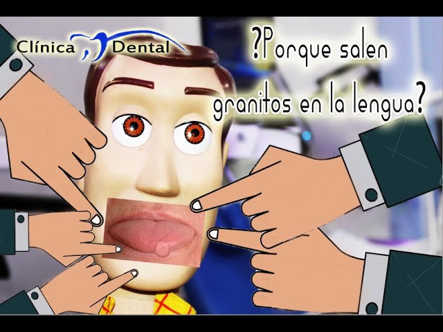 tipos de granitos en la lengua