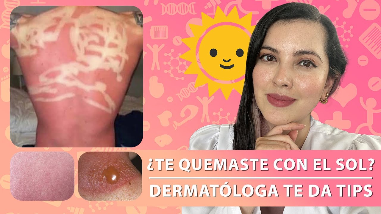 Mascarillas para reparar la piel quemada por el sol