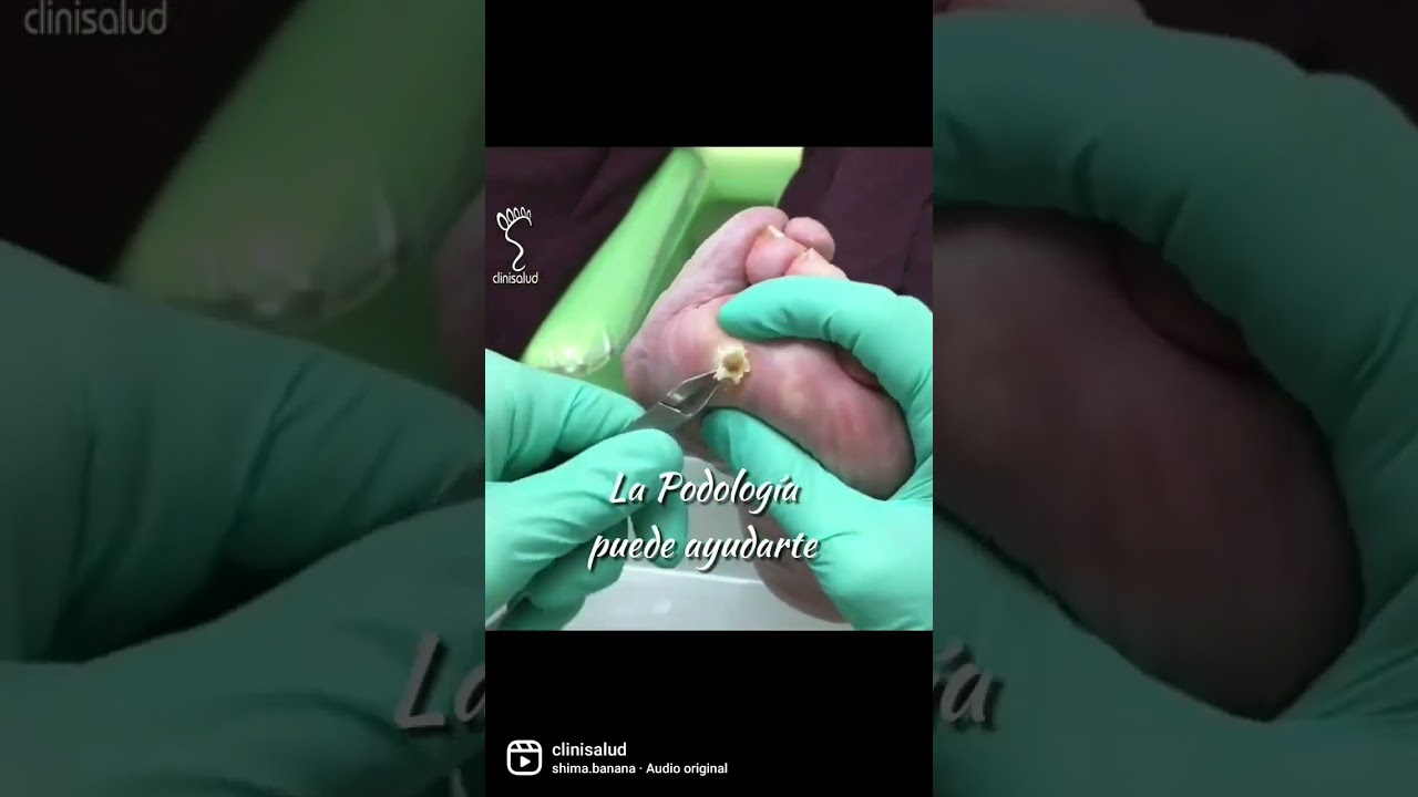 corte en la planta del pie