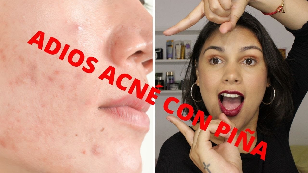 Beneficios asombrosos de la mascarilla de piña para la piel