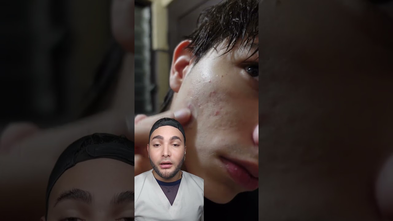Mascarilla natural para combatir el acné y las manchas en la piel