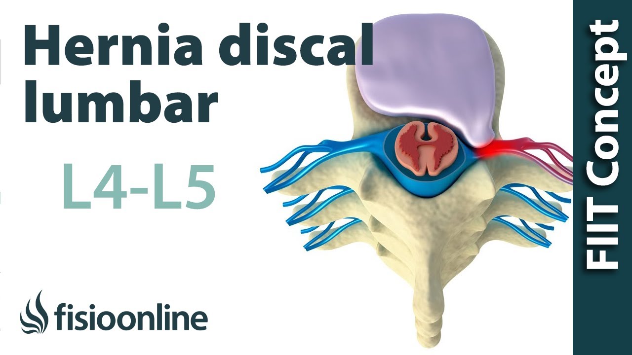 hernia en la l4 y l5