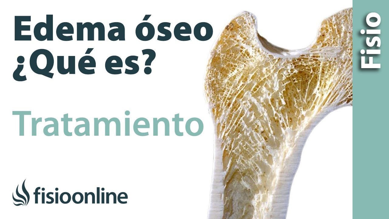 que es un edema oseo en la rodilla