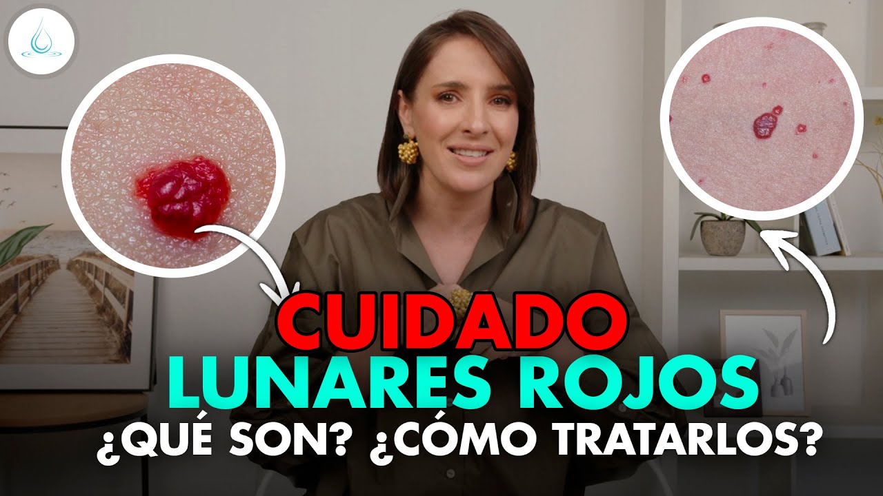 Por qué aparecen lunares rojos en el cuerpo: causas y cuidados