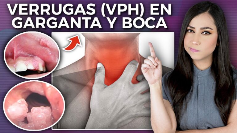 ¿Papiloma en la boca tiene cura? Descubre los tratamientos y soluciones ...