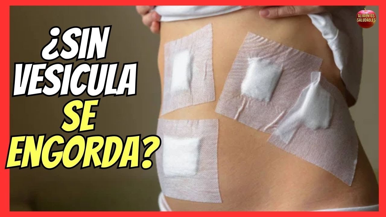 sin vesícula se engorda o adelgaza