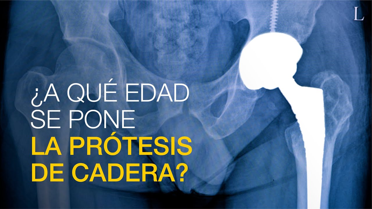 displasia de cadera a los 40 años
